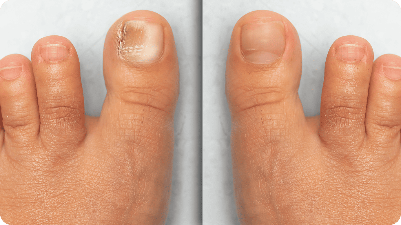 Comparison image showing the appearance of a toenail